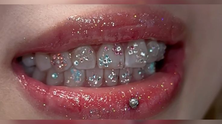 Sparkly multicolor tooth gems on teeth